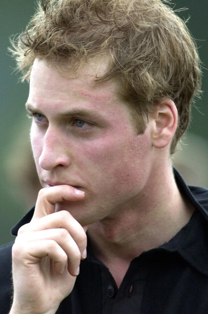 Prince William's scar