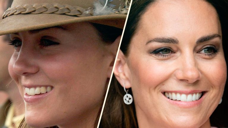 Everything to know about Kate Middleton’s teeth, veneers, braces and a lovely smile Kate Middleton's teeth before and after