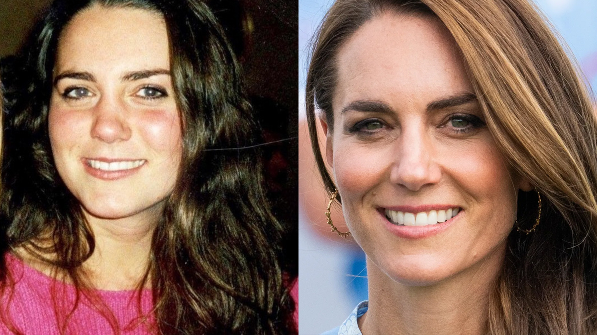 Kate Middleton plastic surgery