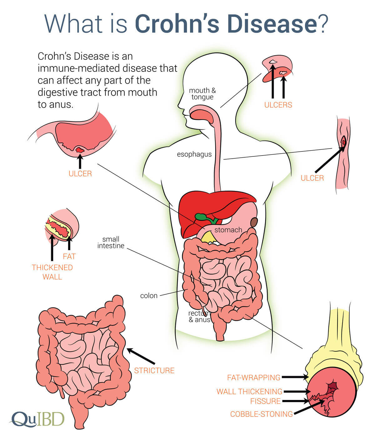 kate middleton surgery colon » Catherine of Wales